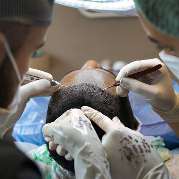 DHI Hair Transplantation Modern-Day Hair Implantation