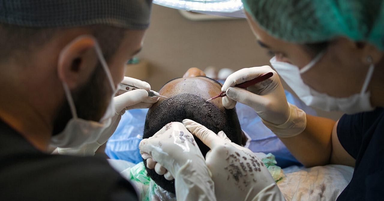 DHI Hair Transplantation Modern-Day Hair Implantation
